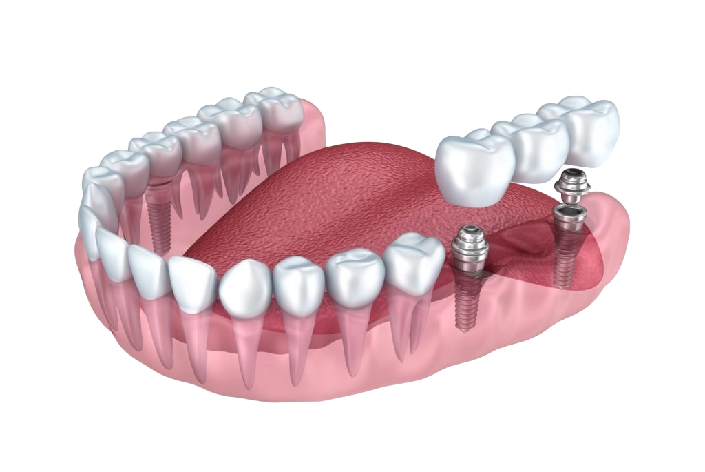 Баннер Протезирование зубов